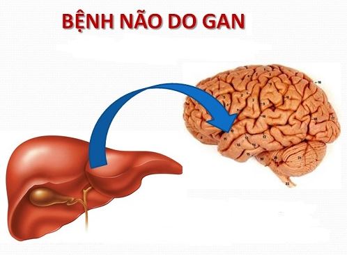 Não gan - Hình ảnh minh họa